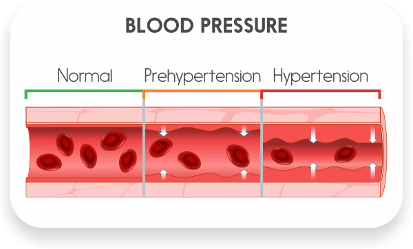 고혈압 혈관의 모습